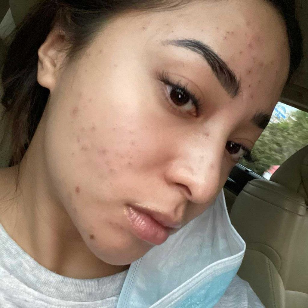 nikita willy artis jerawat berjerawat jerawatan