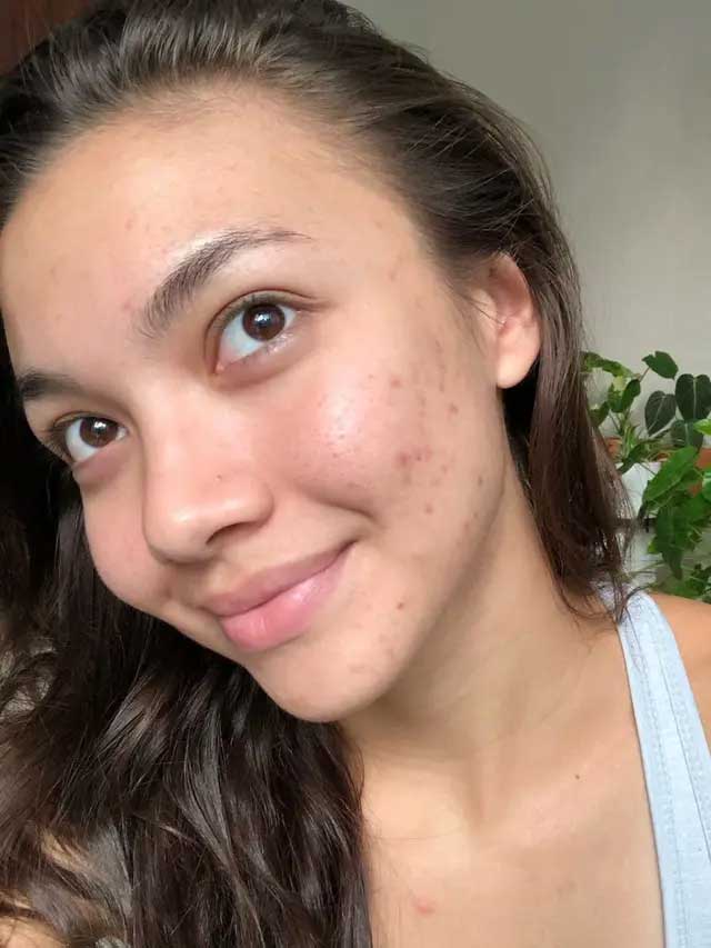 angela gilsha jerawat