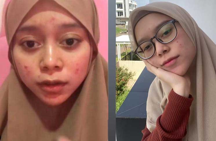 lesti kejora artis jerawat