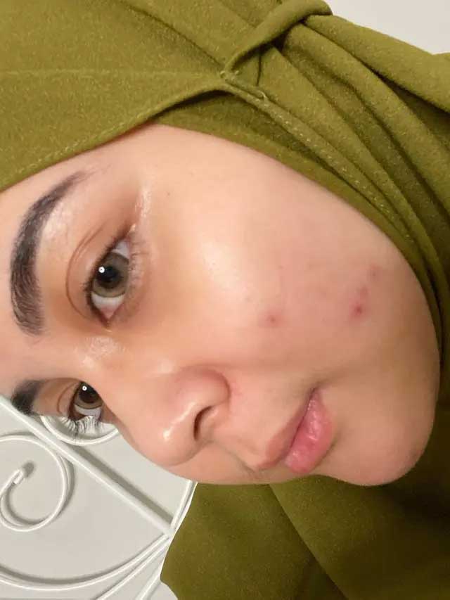 kesha ratuliu artis jerawat