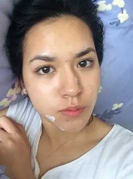 raisa jerawat artis