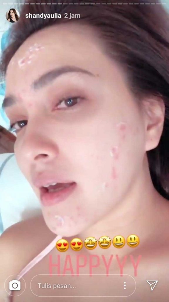 shandy aulia jerawat