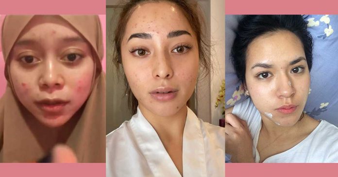artis kulit jerawat berjerawat jerawatan artis kulit jerawat berjerawat jerawatan